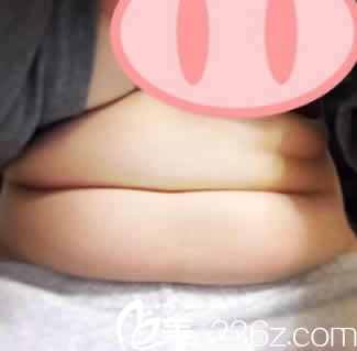 我在<!--<i data=20240703-sp></i>-->整形做腰腹部吸脂前的照片 我在<!--<i data=20240703-sp></i>-->整形做腰腹部吸脂前的照片