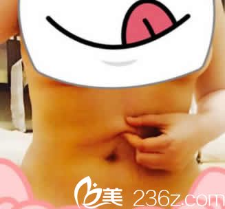 <!--<i data=20240703-sp></i>--><!--<i data=20240703-sp></i>-->給我做水動力腰腹部環(huán)吸后第8天效果 <!--<i data=20240703-sp></i>--><!--<i data=20240703-sp></i>-->給我做水動力腰腹部環(huán)吸后第8天效果