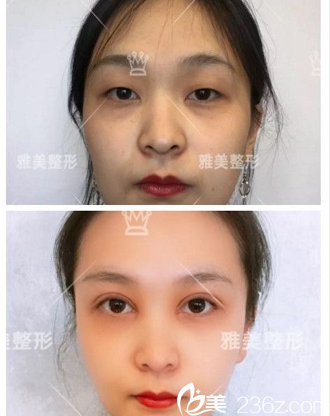 雅美切開雙眼皮真人案例