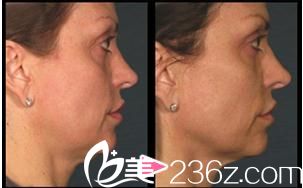 Ulthera 3D照射 Ulthera 3D照射