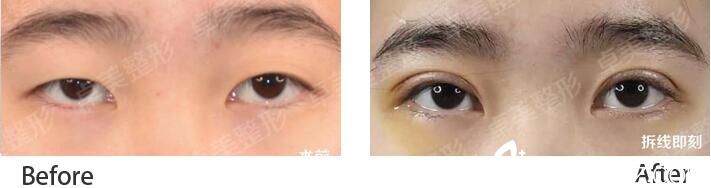 武漢卓美雙眼皮案例