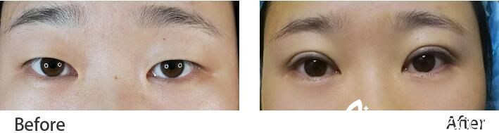 武漢卓美雙眼皮真人前后對(duì)比