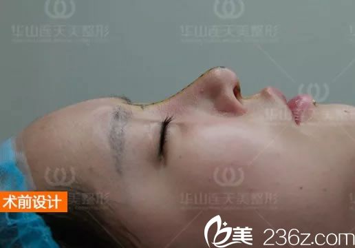 <!--<i data=20240703-sp></i>-->主任為我設(shè)計(jì)的鼻修復(fù)方案 <!--<i data=20240703-sp></i>-->主任為我設(shè)計(jì)的鼻修復(fù)方案