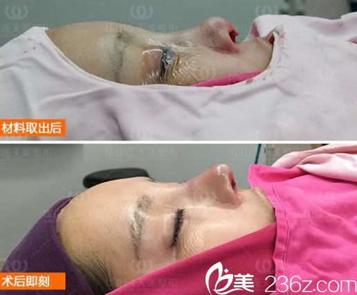 隆鼻后假體取出的照片 隆鼻后假體取出的照片