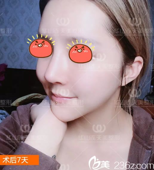 第4次鼻修復(fù)手術(shù)7天恢復(fù)照 第4次鼻修復(fù)手術(shù)7天恢復(fù)照