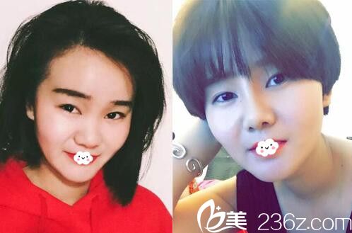 淮北東方美萊塢隆鼻整形真人案例