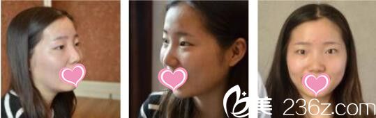 昆明韓辰醫(yī)療美容醫(yī)院肖育亮切開法雙眼皮真人案例術(shù)前照 昆明韓辰醫(yī)療美容醫(yī)院肖育亮切開法雙眼皮真人案例術(shù)前照