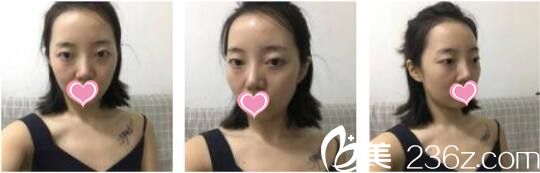 昆明韓辰醫(yī)療美容醫(yī)院王德寧全切雙眼皮真人案例術(shù)前照 昆明韓辰醫(yī)療美容醫(yī)院王德寧全切雙眼皮真人案例術(shù)前照