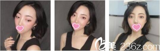 昆明韓辰醫(yī)療美容醫(yī)院王德寧全切雙眼皮真人案例術(shù)后兩個(gè)月 昆明韓辰醫(yī)療美容醫(yī)院王德寧全切雙眼皮真人案例術(shù)后兩個(gè)月