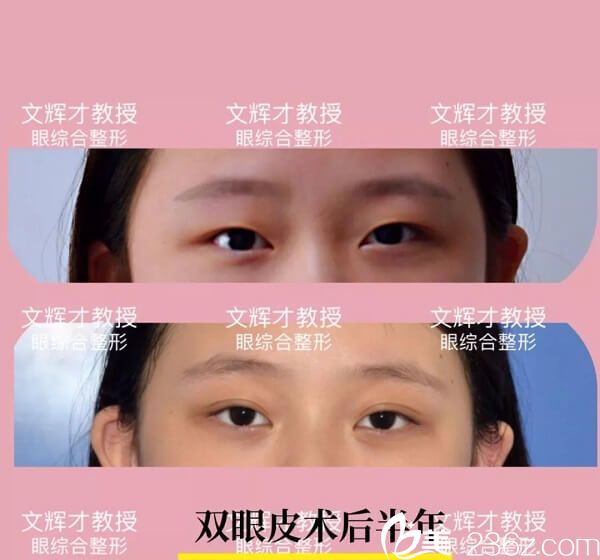文輝才雙眼皮手術(shù)案例分享