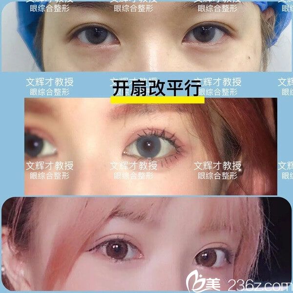 文輝才雙眼皮手術(shù)案例分享