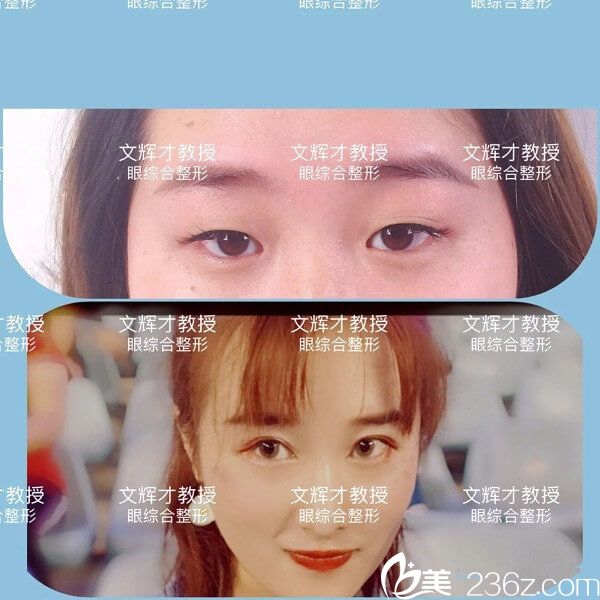 文輝才雙眼皮手術(shù)案例分享
