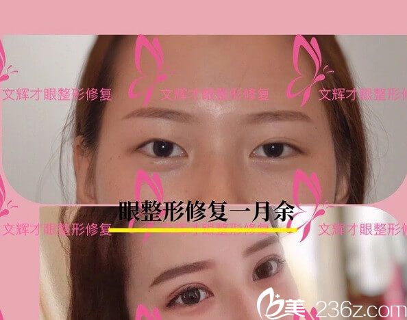 文輝才雙眼皮手術(shù)案例分享