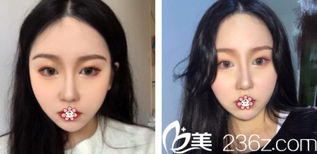 重慶曹陽麗格整形面部吸脂怎么樣