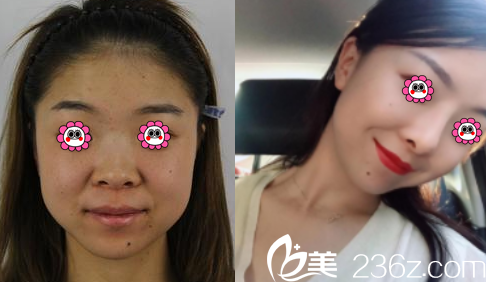 云南華美美萊隆鼻案例