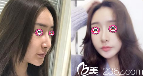 云南華美美萊鼻修復(fù)案例