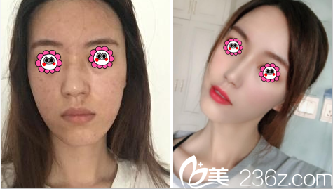 昆明夢想隆鼻案例