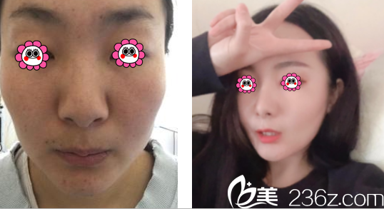 昆明美伊萊鼻綜合案例