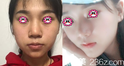 昆明吳氏嘉美隆鼻案例