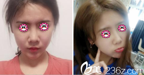 昆明吳氏嘉美鼻修復(fù)案例