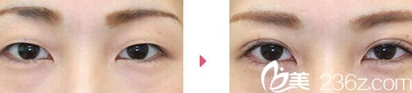 雙眼皮手術(shù)效果 雙眼皮手術(shù)效果
