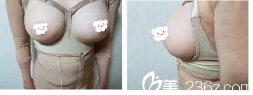 郭峰給我做假體隆胸手術(shù)一個月了 郭峰給我做假體隆胸手術(shù)一個月了