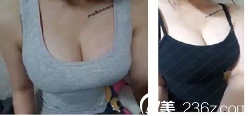 術(shù)后三個月 術(shù)后三個月