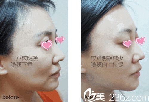 PPDO面雕提拉對(duì)比效果 PPDO面雕提拉對(duì)比效果