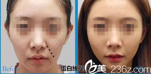 PPDO面雕提拉的有效部位 PPDO面雕提拉的有效部位