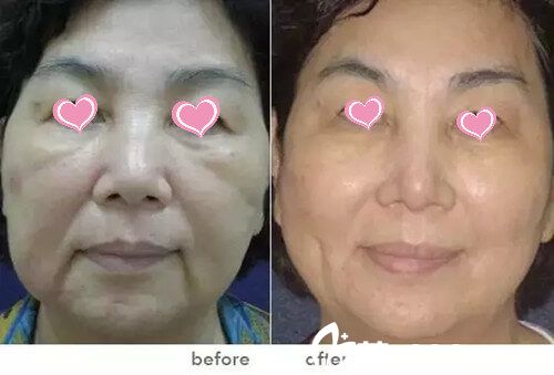 1.webp.jpg PPDO面雕提拉的有效部位 1.webp.jpg PPDO面雕提拉的有效部位