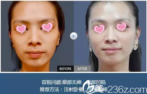 袁抒懷醫(yī)生微整手術(shù)真人案例展示 袁抒懷醫(yī)生微整手術(shù)真人案例展示