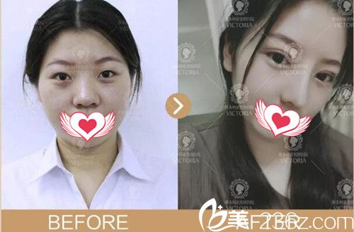南京維多利亞整形雙眼皮+鼻綜合+玻尿酸案例效果 南京維多利亞整形雙眼皮+鼻綜合+玻尿酸案例效果