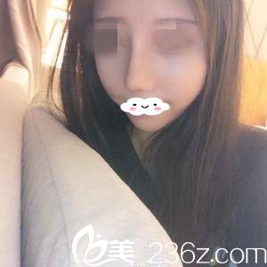 別糾結(jié)到底是做硅膠隆鼻還是自體軟骨隆鼻？看佳木斯韓藝來的隆鼻真人案例分享