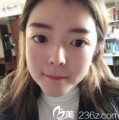 廣州韓妃雙眼皮開眼角術(shù)后15天