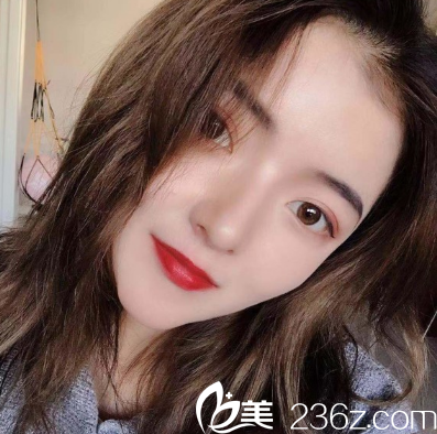 廣州韓妃<!--<i data=20240703-sp></i>-->軍雙眼皮開眼角兩個月案例圖