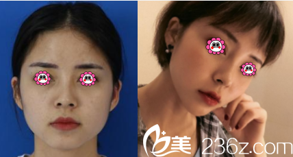 云南華美美萊面部自體脂肪填充案例