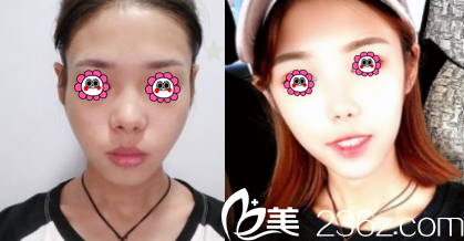 昆明吳氏嘉美面部脂肪填充案例