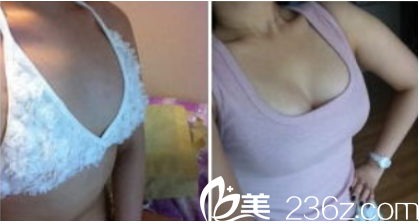 昆明吳氏嘉美自體脂肪豐胸案例