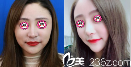 北京藝美鞏敏自體脂肪面部填充案例 北京藝美鞏敏自體脂肪面部填充案例