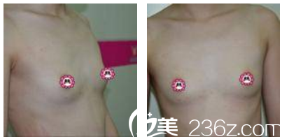 在廣州海峽做隆胸手術(shù)前 在廣州海峽做隆胸手術(shù)前