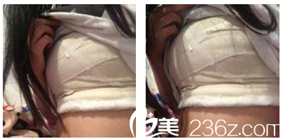 在廣州海峽做完隆胸術(shù)后天 在廣州海峽做完隆胸術(shù)后天