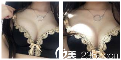 假體隆胸術(shù)后三天恢復(fù)效果 假體隆胸術(shù)后三天恢復(fù)效果