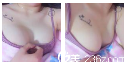 閆愛躍做的280CC傲諾拉假體隆胸半個(gè)月效果圖 閆愛躍做的280CC傲諾拉假體隆胸半個(gè)月效果圖