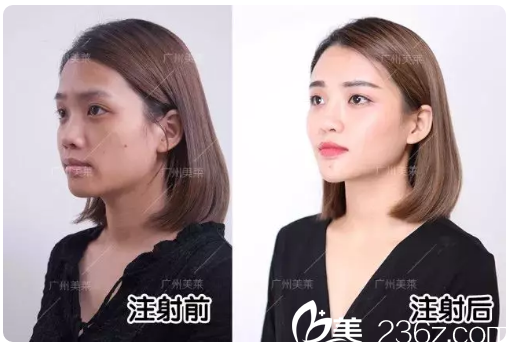 廣州美萊玻尿酸注射全臉案例效果 廣州美萊玻尿酸注射全臉案例效果