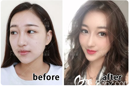 廣州美萊羅延平做的隆鼻案例 廣州美萊羅延平做的隆鼻案例