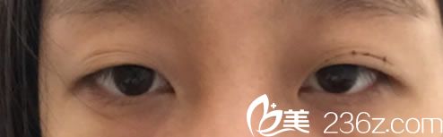 在杭州詮昕做雙眼皮手術(shù)前 在杭州詮昕做雙眼皮手術(shù)前