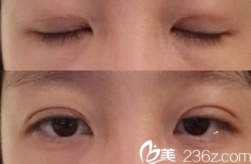 做完雙眼皮手術(shù)7天恢復(fù)照片 做完雙眼皮手術(shù)7天恢復(fù)照片