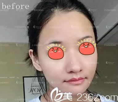 在杭州詮昕做玻尿酸豐下巴前 在杭州詮昕做玻尿酸豐下巴前