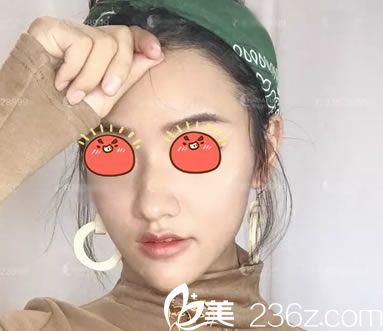 今天在這里和大家分享下我在杭州詮昕陳曉曉處做玻尿酸豐下巴蛻變史