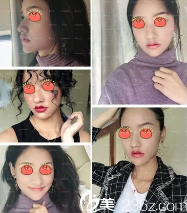 杭州詮昕陳曉曉玻尿酸豐下巴<span style= 杭州詮昕陳曉曉玻尿酸豐下巴<span style=